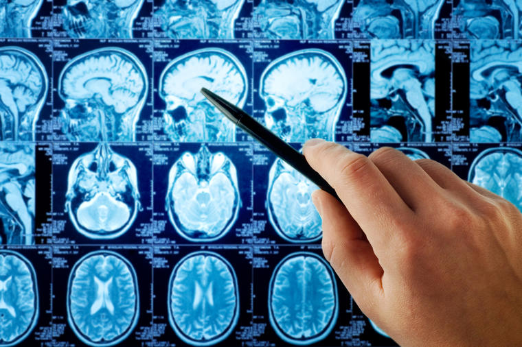 Tihi signali koje svi ignorišemo; 8 simptoma tumora na mozgu