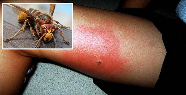Kada vas ubode osa, stršljen ili pčela – ovo će vas spasiti bola i otoka!