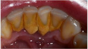 Ako želite ukloniti kamenac sa zubi ne morate ići stomatologu